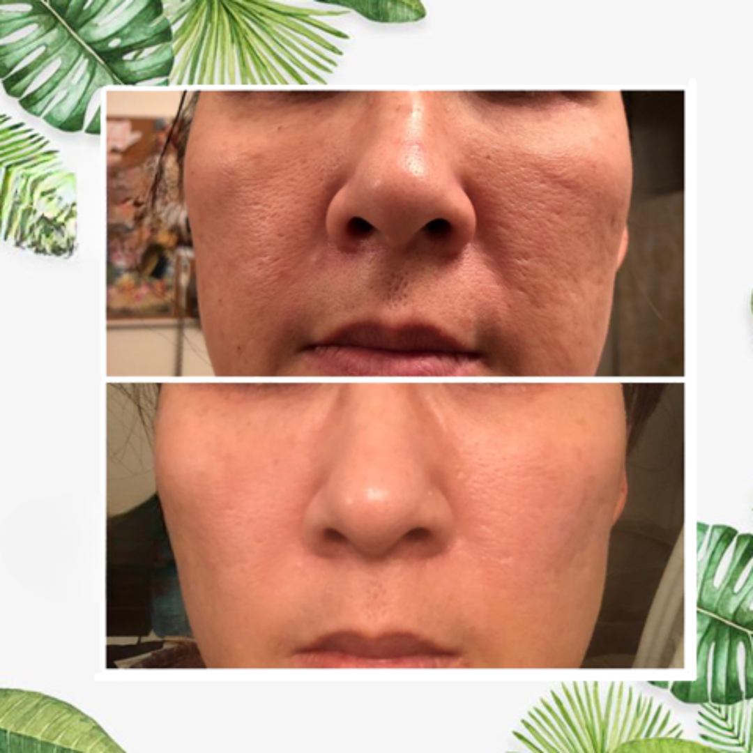 Stick Maschera Viso per Pelle Grassa Detox