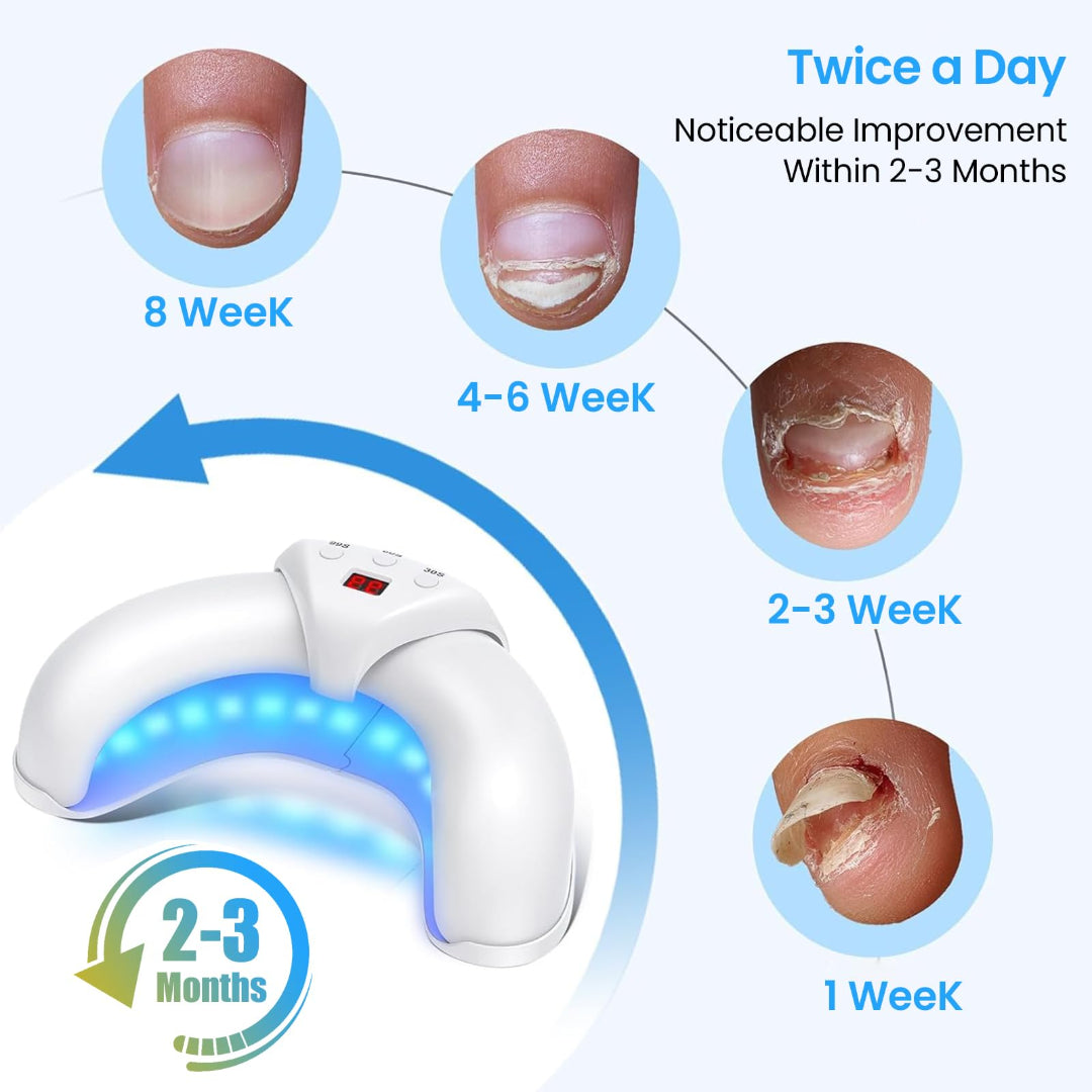 Laser Nail Fungus Removal Home Treatment Device 2