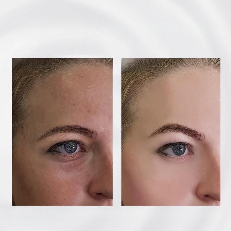 cooling-undereye-roller-for-pu-2-m9ehw6